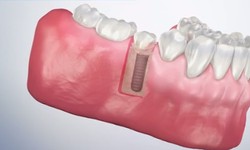 What should you know about the dental implants?
