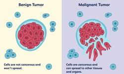 Understanding Tumors and Cancer: Key Differences and Similarities
