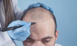 Crowning Glory Restored: Hair Transplant Masters