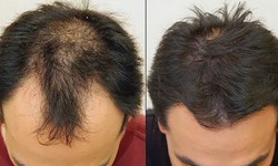 "Transforming Lives, One Hair Follicle at a Time"