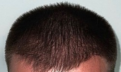 Hair Loss Reversed: The Magic of PRP Treatment