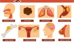 Unveiling the Diverse World of Cancer: Types of Liver and Kidney Cancer