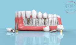 Dental Implants Unveiled: Your Path to a Confident Smile (DoctorPrem)