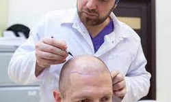 The Qualities That Set Hair Transplant Experts Apart from the Rest