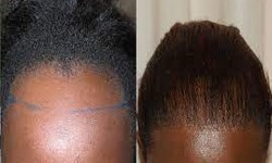 Hair Transplantation for Afro-Textured Hair: What to Expect