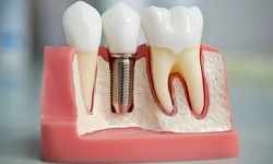 Why Choose Dental Implants Over Dentures