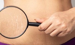 What to Expect During and After Laser Stretch Marks Removal