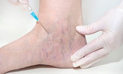 Beyond the Surface: Comprehensive Spider Veins Therapy
