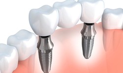 Dental Implants In Toronto: A Complete Overview
