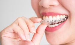 Get the Smile of Your Dreams with Invisalign at Discovery Dental