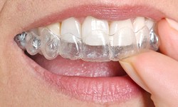 Get Your Dream Smile! Why Hillsboro Dental's Invisalign Service is Unmatched
