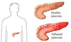 Pancreatitis Demystified: A Closer Look at Risk Factors and Prevention