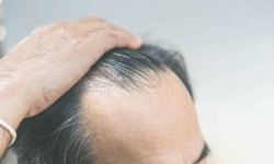 The Psychology of Hair Loss: Emotional Healing thru Transplants surgical procedure"
