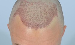 A Closer Look at Modern Hair Restoration Techniques