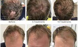 Transform Your Look with HD Hairlines: Unveiling the Life-Changing Power of Scalp Micropigmentation (SMP) with UK Specialists