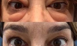 Understanding Bulging Eyes: Causes, Symptoms, and Treatment Options