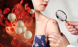 Lymphoma Rash: When A Blood Cancer Attacks The Skin