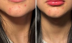 The Truth About Lip Plumpers: Do They Work?