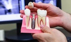 Dental Implant Benefits: Beyond Aesthetics, Improving Oral Health