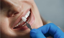 How Composite Bonding Can Improve Your Smile with Veneers