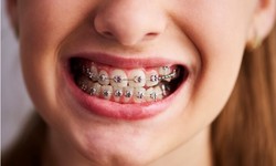 Behind-the-Scenes Smiles: The Wonders of Lingual Braces Unveiled