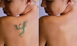 "Erasing the Past: The Power of Laser Tattoo Removal"
