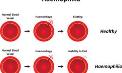 Hemophilia: A Journey from Diagnosis to Hopeful Treatments