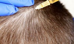 Future Trends in Hair Restoration: What to Expect