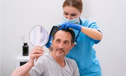 Unlocking Confidence: Your Guide to the Best Alopecia Specialist in London