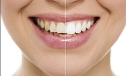 Unveiling the Art of Smile Transformation: The Magic of Composite Bonding