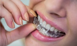 Achieve Straight Teeth Discreetly with Invisalign in Orpington