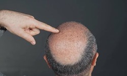 The Pinnacle of Hair Transplantation: The Numerous Benefits of Follicular Unit Extraction (FUE)