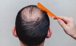 Decoding Hair Transplantation and Choosing the Right Hair Products