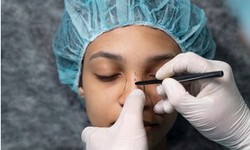 Nose Perfection: The Art and Science of Non-Surgical Rhinoplasty