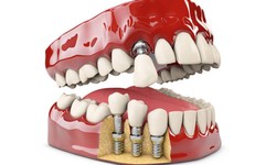 Rediscovering Smiles: The Transformative Power Of Dentures In London