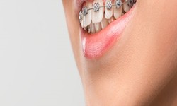 How to Choose the Best Orthodontist in Dubai?