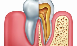 All About Root Canal Treatment: Dubai's Leading Experts