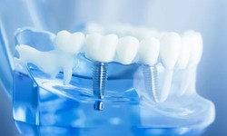 Smile Restoration: The Core Benefits of Dental Implants