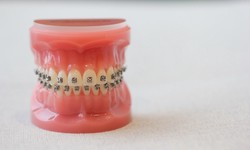 Perfecting Smiles: Invisalign in Redmond and the Art of Kirkland Braces