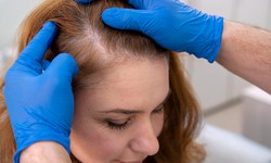 Transform Your Look with FUE Hair Transplant in Perth
