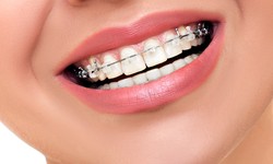 Achieve Your Dream Smile with Mack Orthodontics: Cincinnati's Premier Invisalign Experts