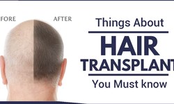 Which Things to Remember Before Having a Hair Transplant?