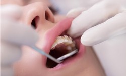 Precision and Perfection: Inside the Top Dental Clinics in Antalya, Turkey