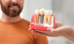 How Dental Implants Help Patients Smile Confidently
