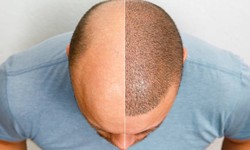 Follicle Frontier: A Deep Dive into the World of Hair Transplant Procedures