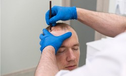 Strand by Strand: Understanding the Process of Hair Transplant in Harrow