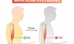 Dystrophin Dynamics: Charting the Course of DMD Advancements