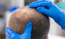 How to Find the Best Hair Transplant Centre in Turkey - Follow a Few Key Steps
