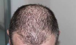 How long does it take to feel normal after hair transplant?