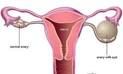 "Swift Liberation: The Journey of Ovarian Cyst Removal"